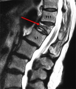 Vertebral Compression Fracture | e-algos