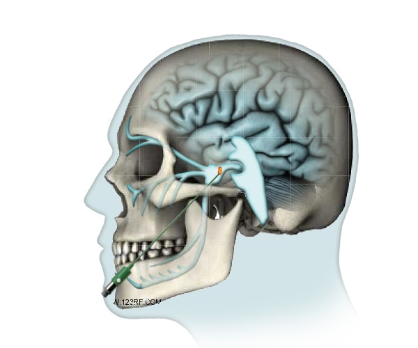 Trigeminal Neuralgia