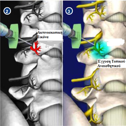 Diagnostic Facet Joint Block