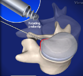 Intervertebral Disc Decompression