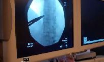 Splachnic Nerves Block