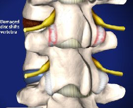 Facet Joint Syndrome