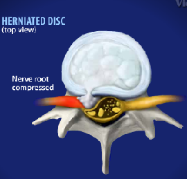 Intervertebral Herniated Disc