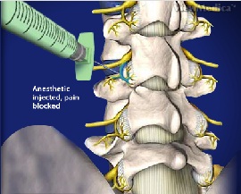 Diagnostic Facet Joint Block