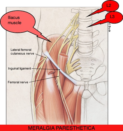 Meralgia Paraesthetica