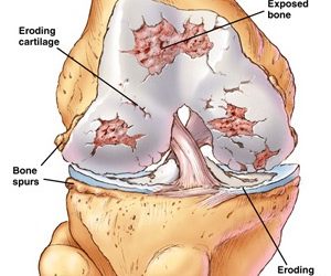 Νέα Αποτελεσματική Τεχνική Ανακούφισης από τον Πόνο της Οστεοαρθρίτιδας Γόνατος